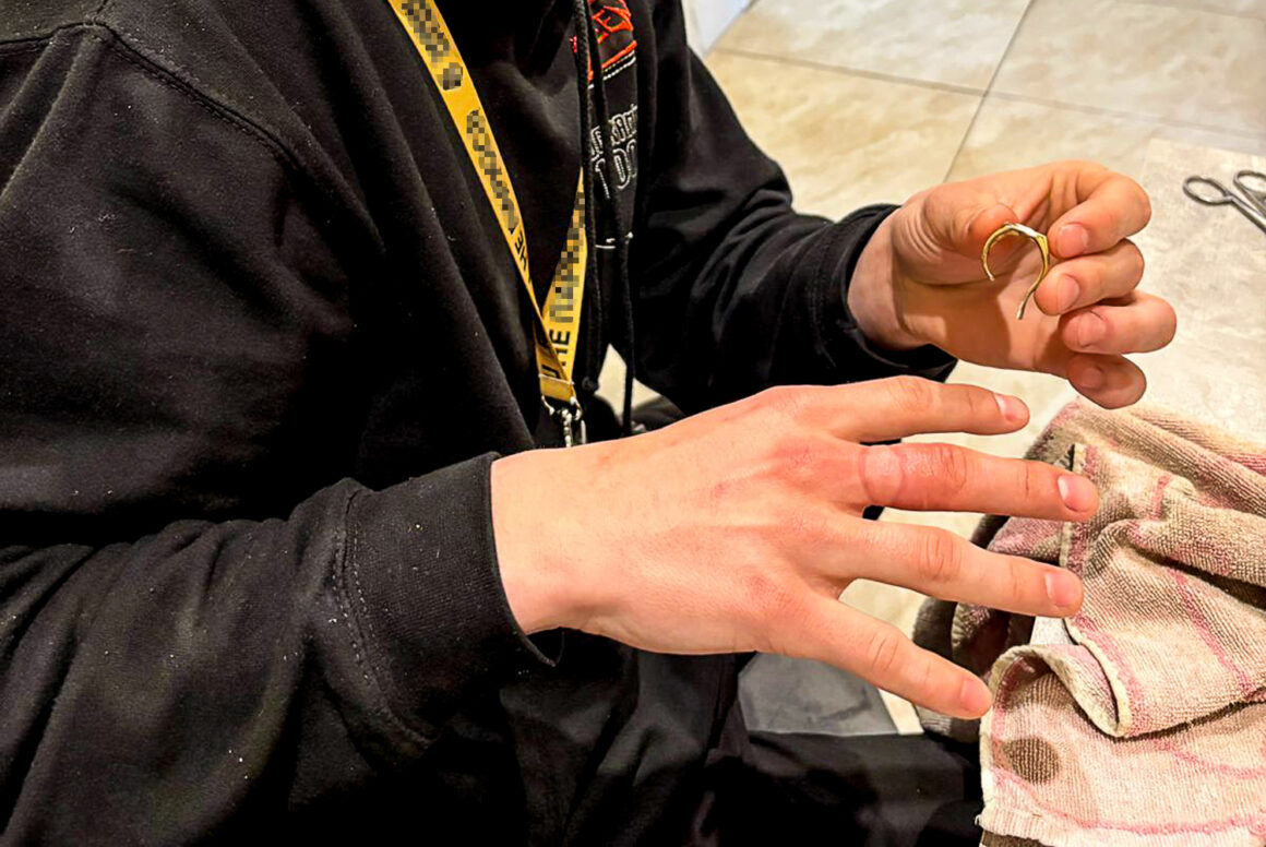 Рятувальники звільнили вінничанина від перстня, який перетиснув палець