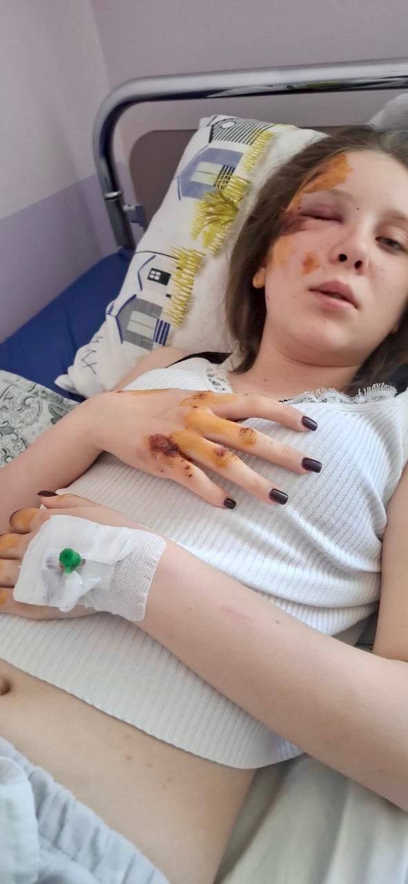 Закрила сестру собою: історія 15-річної Софії сколихнула Ладижин
